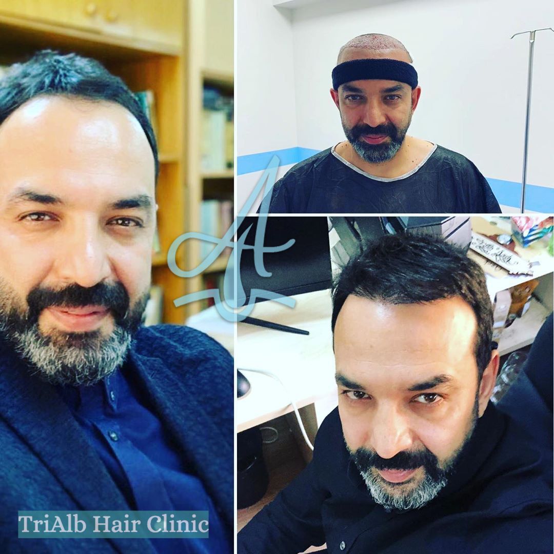 Mbjellja e Flokeve Before After