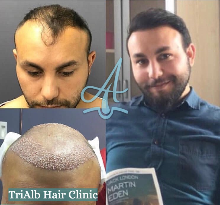 Mbjellja e Flokeve Before After