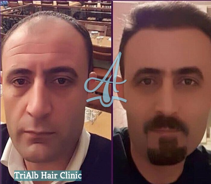 Mbjellja e Flokeve Before After