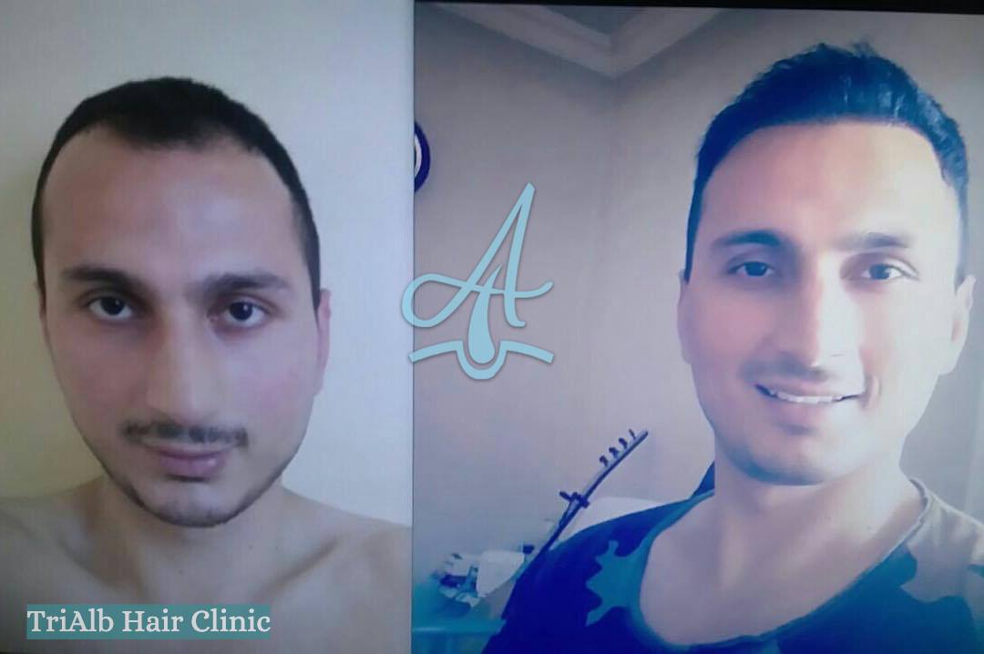 Mbjellja e Flokeve Before After