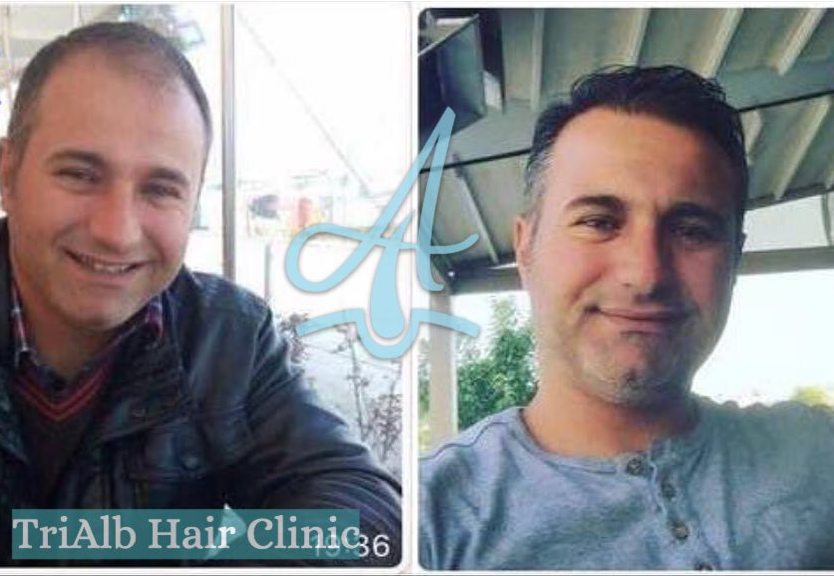 Mbjellja e Flokeve Before After